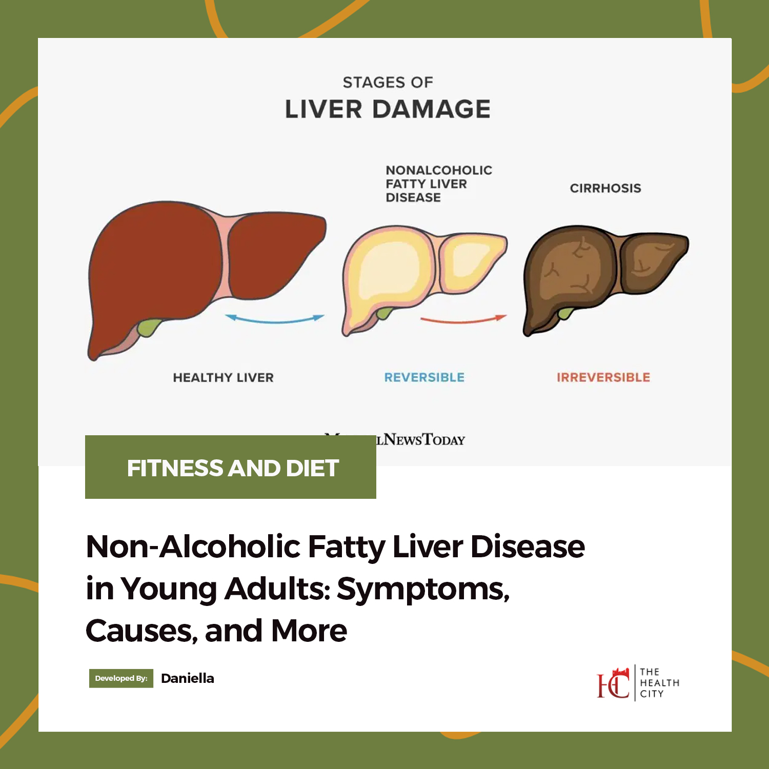 TheHealthCity Non Alcoholic Fatty Liver Disease In Young Adults 